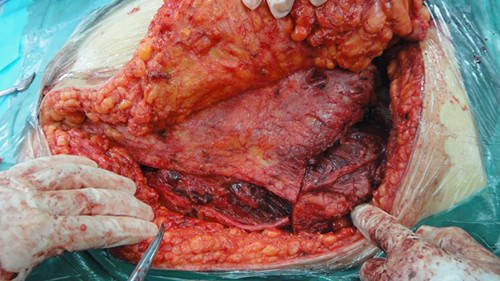 腰间盘突出做完微创手术两周以后腿弯就像烧着